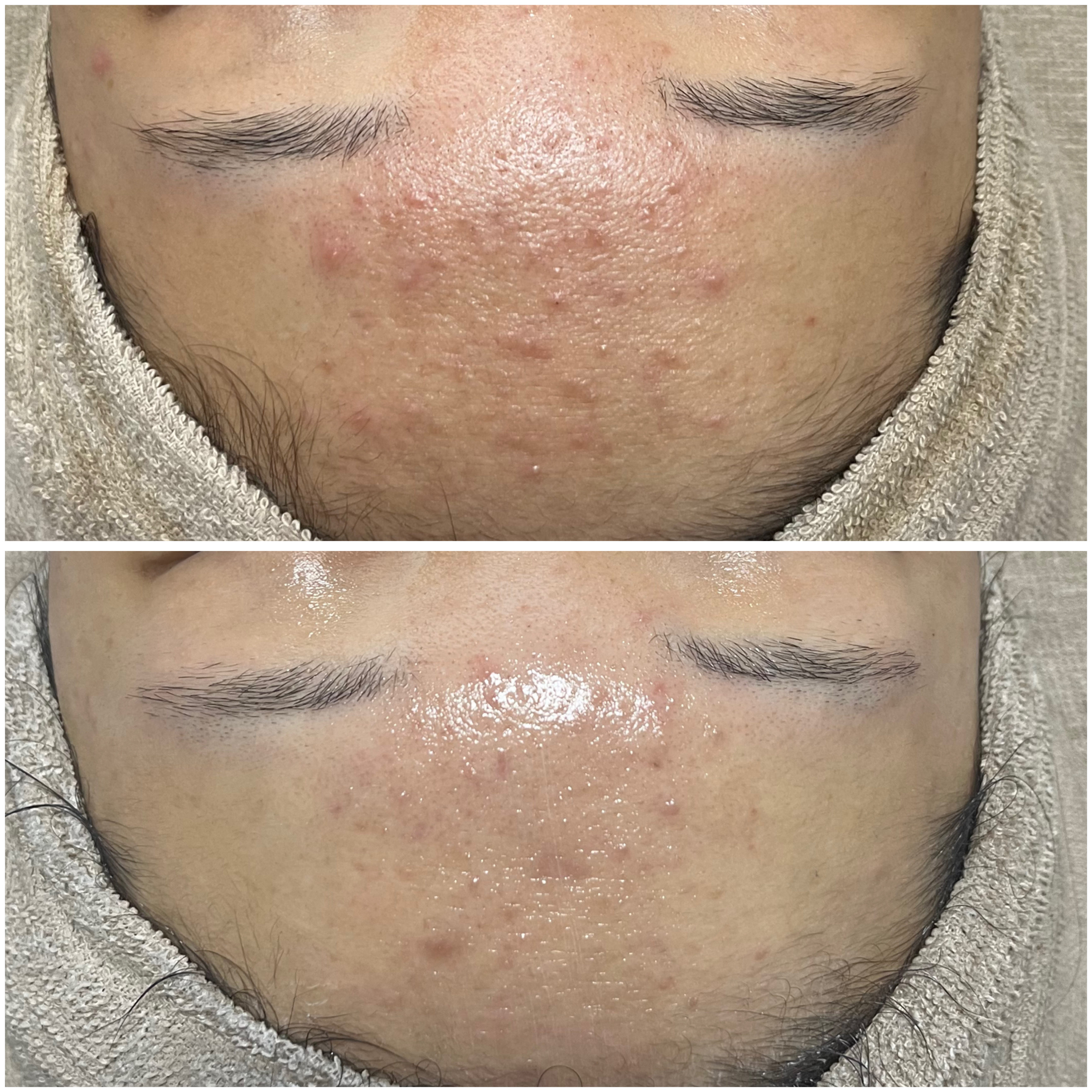 【ハーブピーリング症例】大分ニキビ・毛穴改善サロン