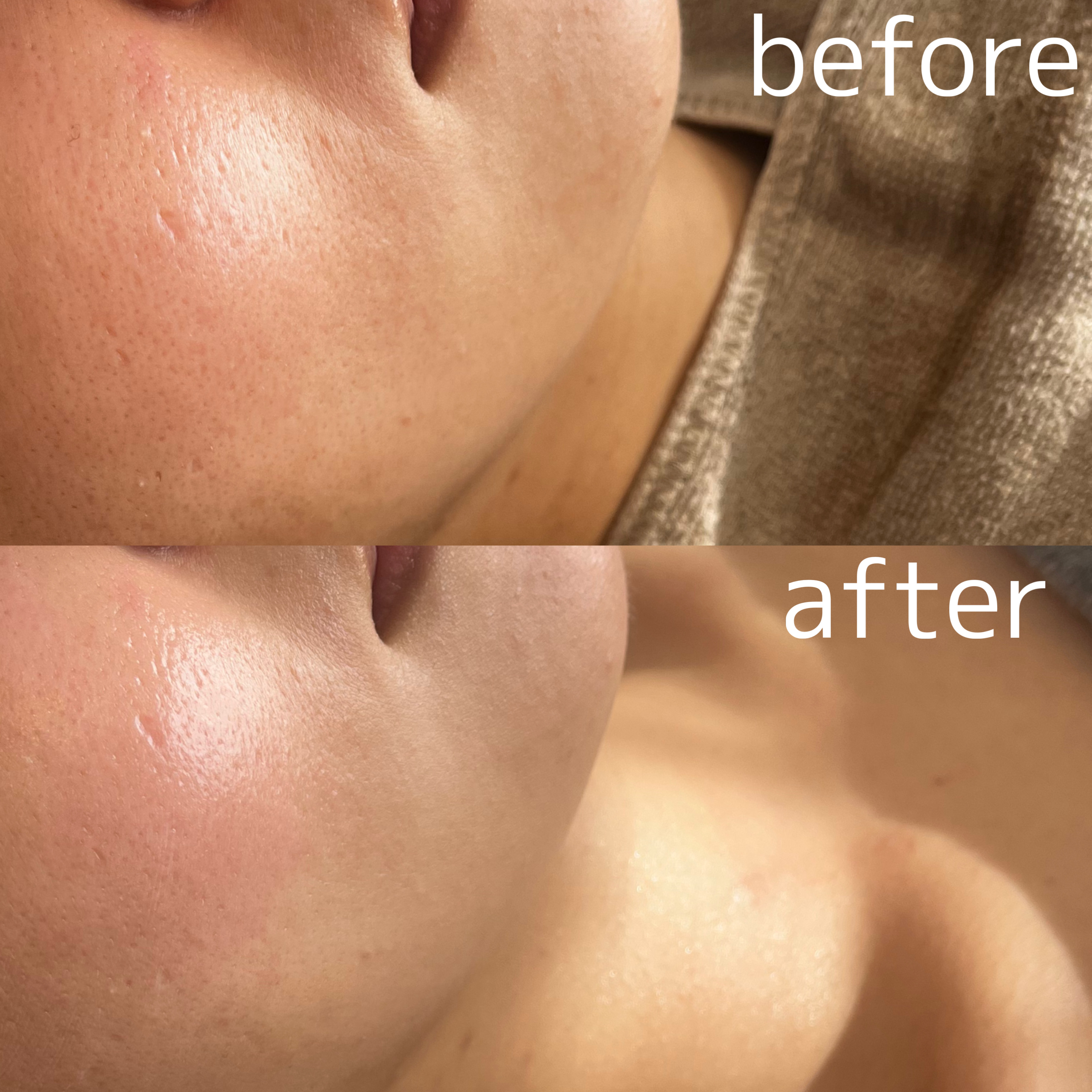 【第5世代ピーリング症例】周年キャンペーン活用される方100%🩷#大分エステサロン