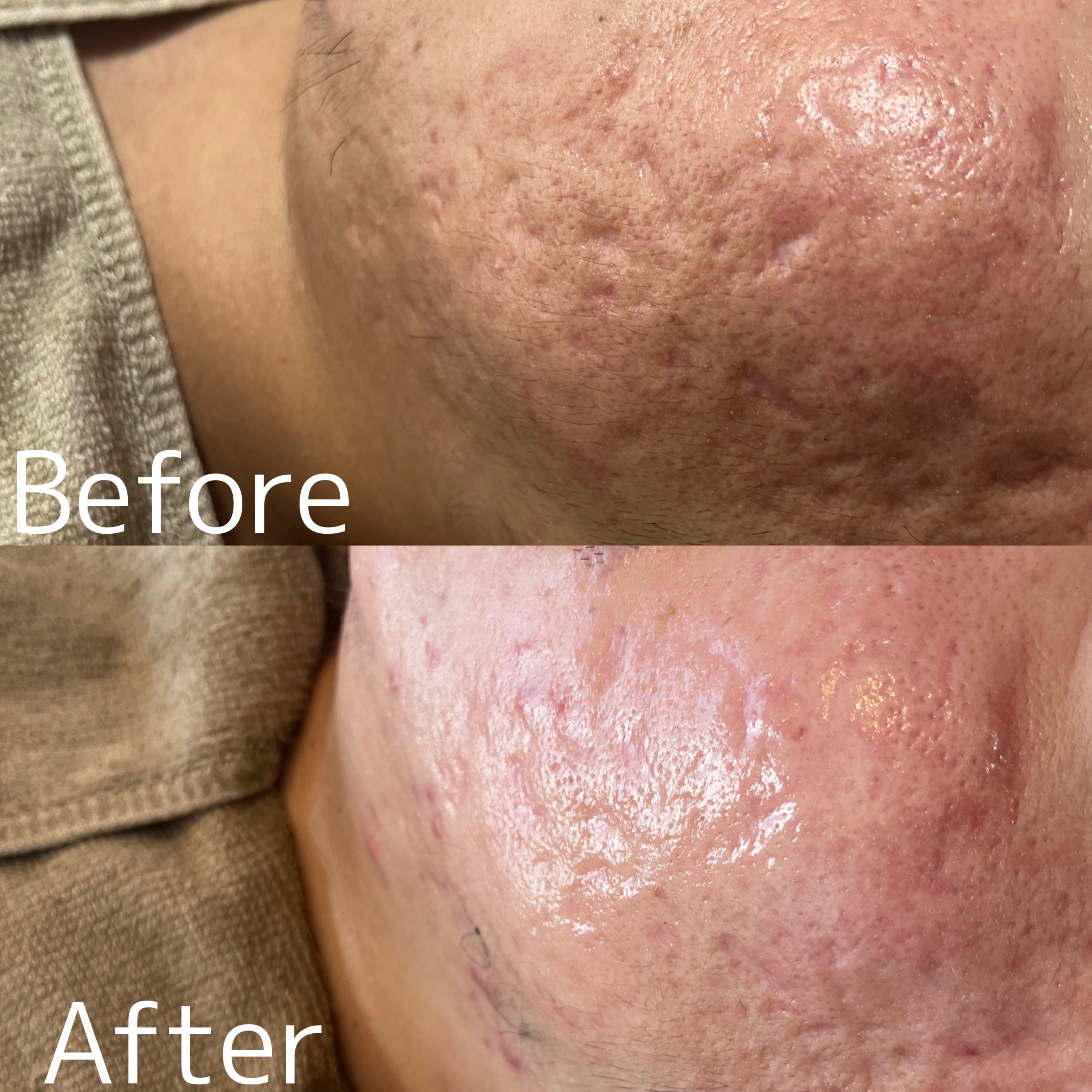 【ハーブピーリング＋光フォト症例】ニキビ・クレーター肌が3ヶ月で改善#大分エステ