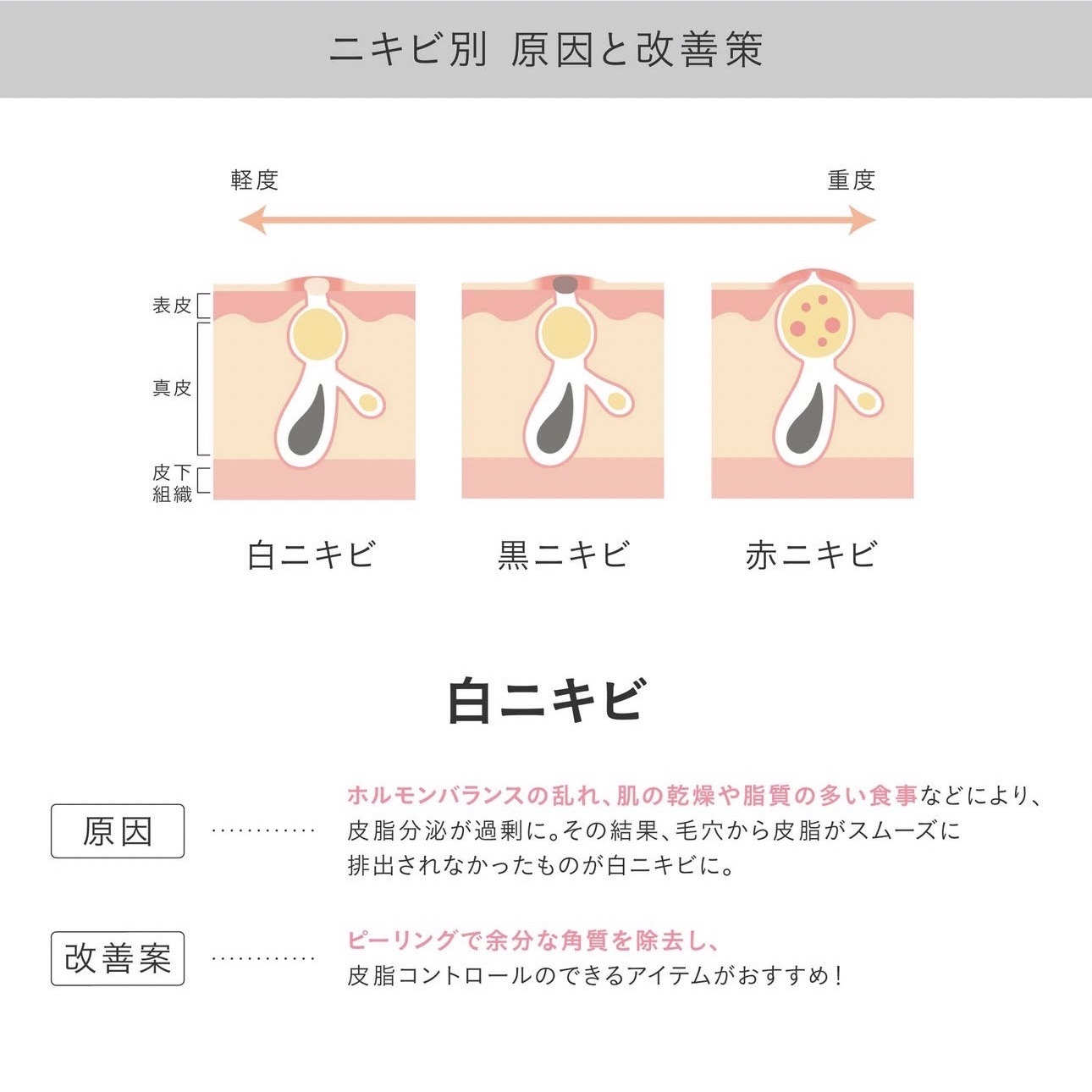 ニキビの種類と原因、解決方法