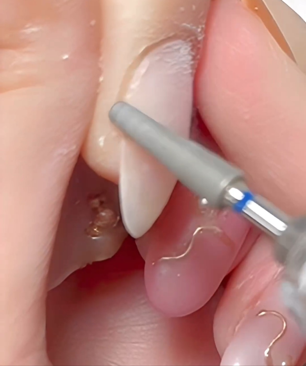 フィルインとは？ネイルスクール生・ネイリスト向け｜やり方・メリット・おすすめビットを解説