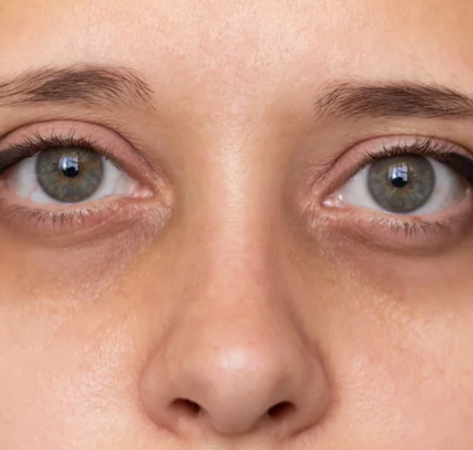 目元のクマは「目の使いすぎ」だけじゃない!?