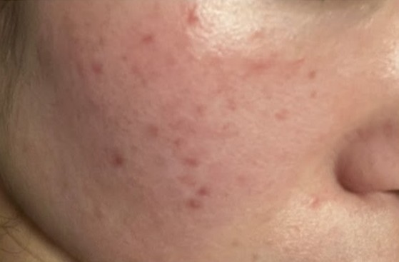 クレームゼロのハーブピーリングへ。施術後の「赤み・剥離」を感動に変える伝え方