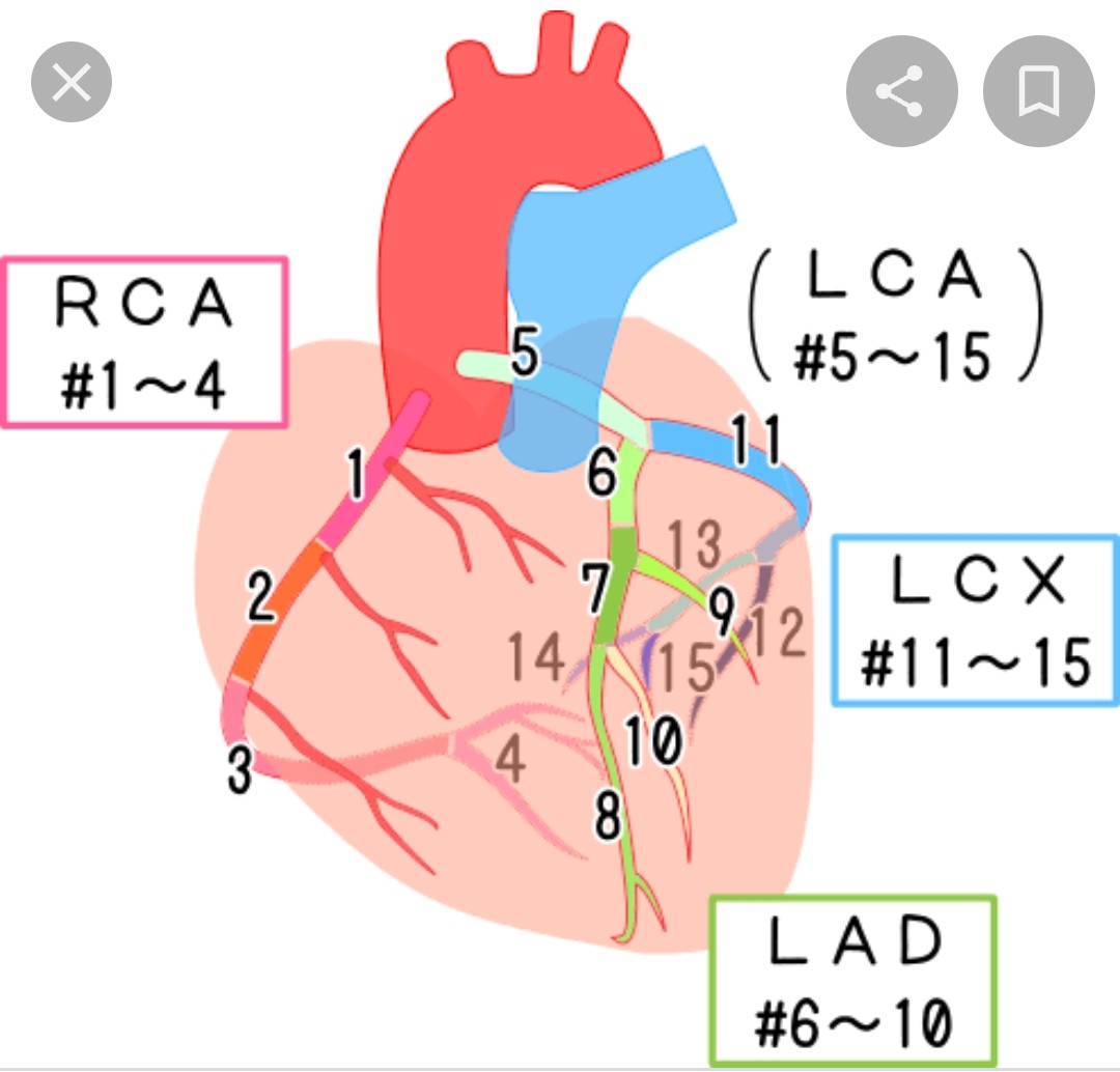 心筋梗塞で手術