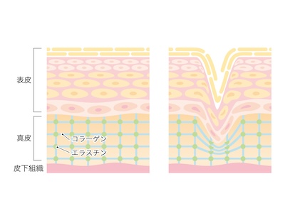 肌の乾燥と皺(シワ)の関係