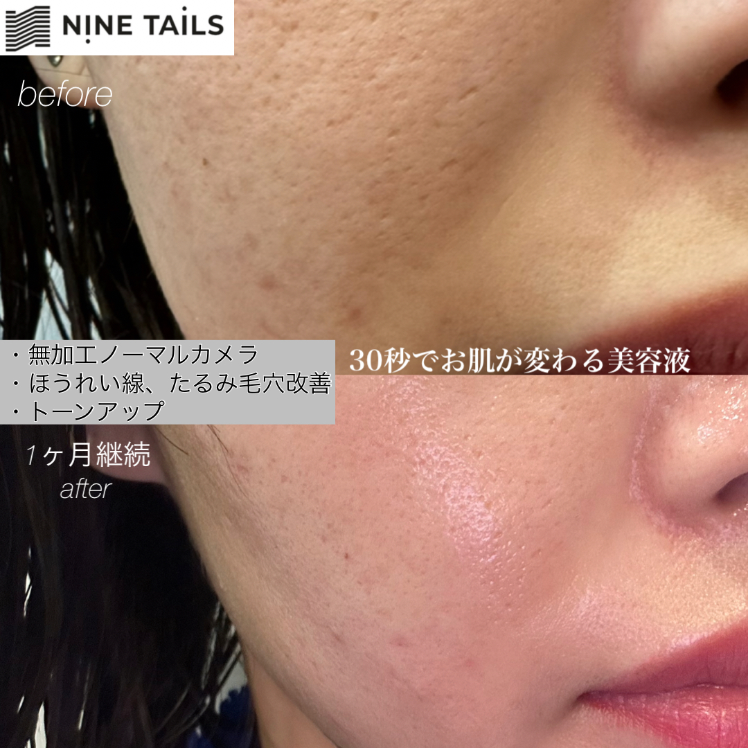 Before/After 継続1ヶ月、5ヶ月Ver...