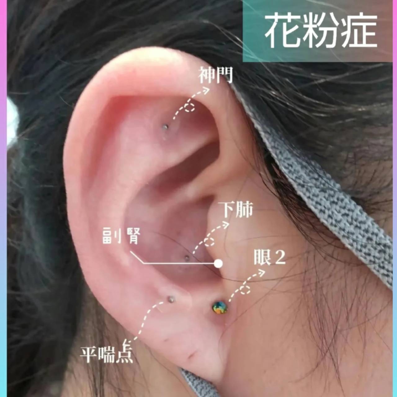 ①花粉症