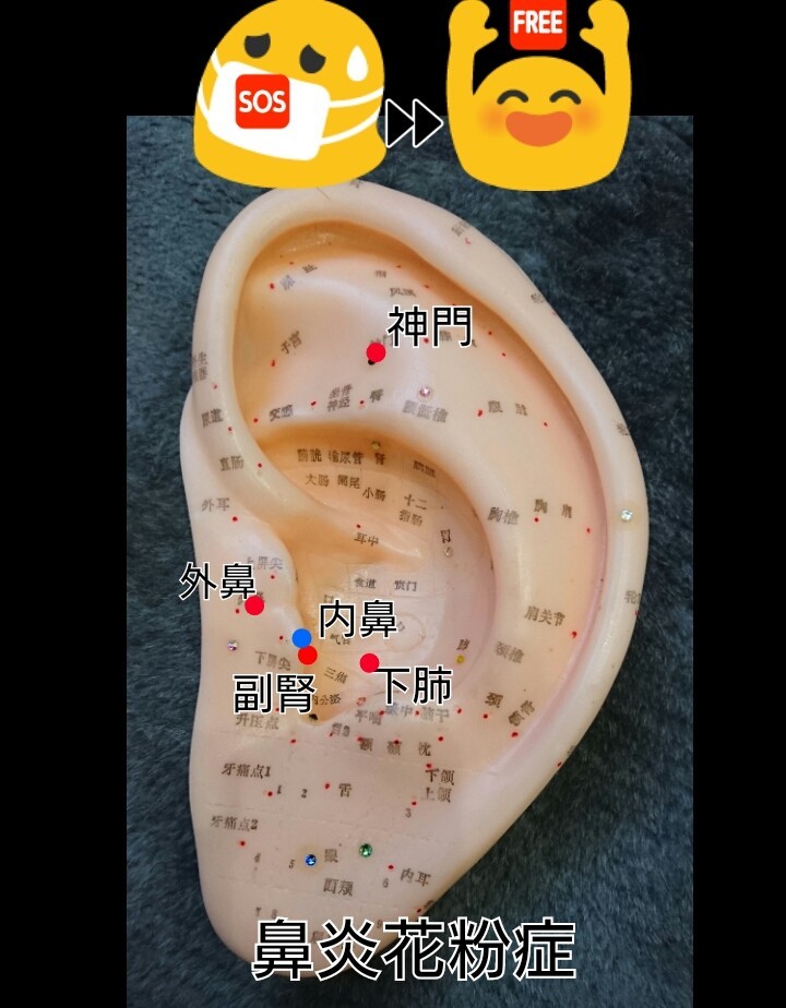 ①花粉症対応耳つぼ(鼻炎タイプ)