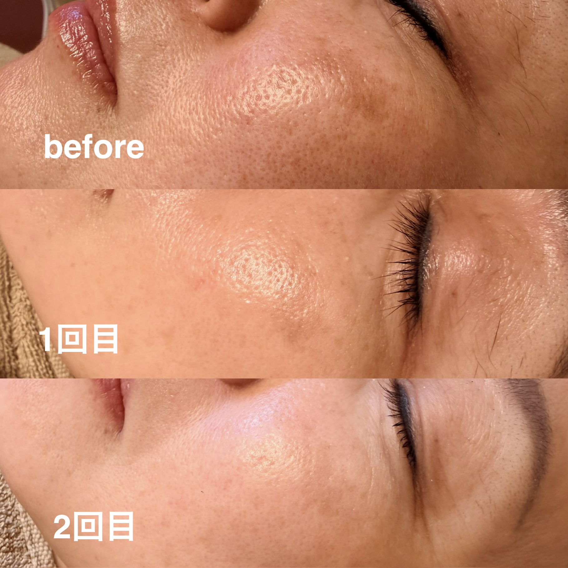 【クリニック治療後の色素沈着でお悩みだったお客様】