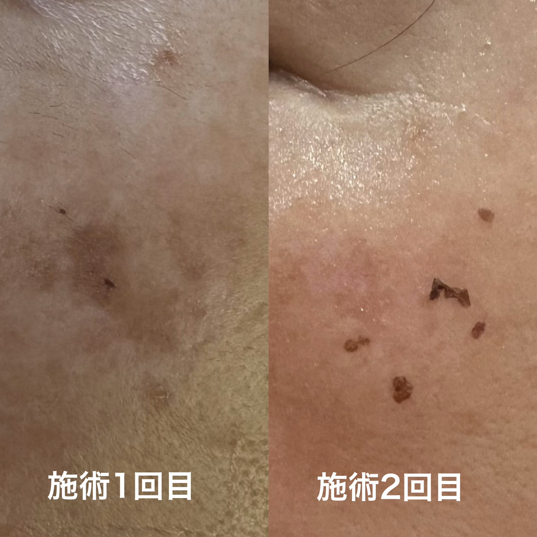 シミ取り増えてます‼︎