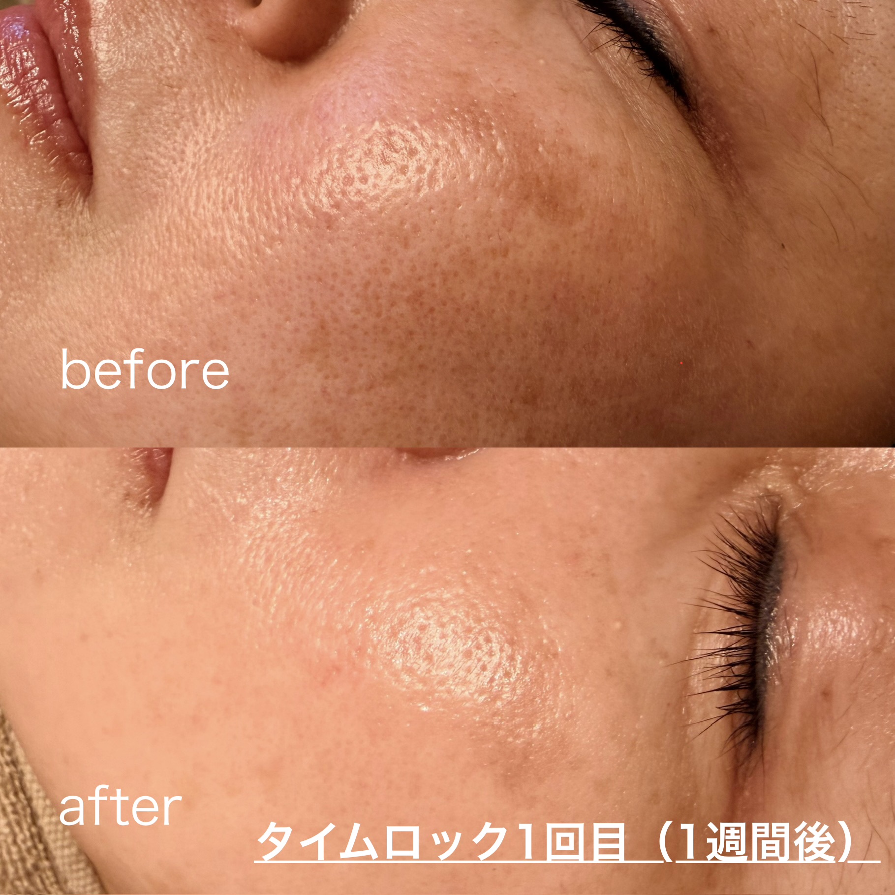 【クリニック治療後の色素沈着に悩んでいたお客様】