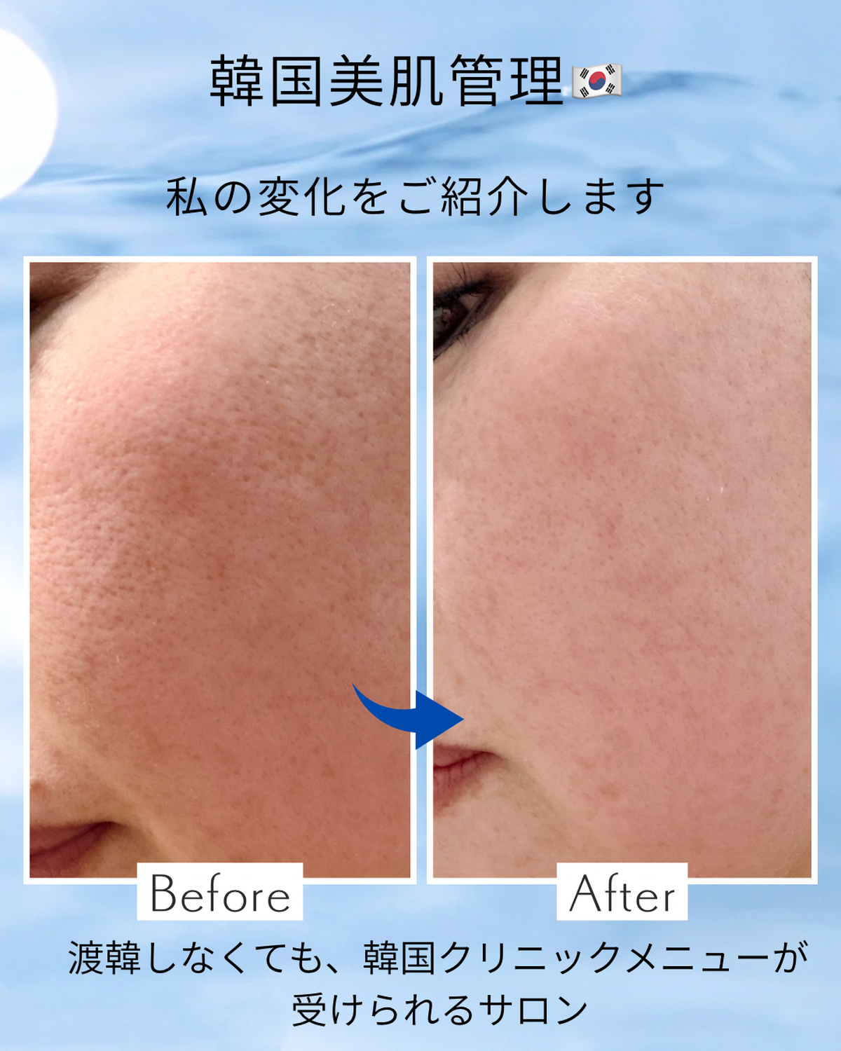 明石市大久保町｜肝斑でも受けられるタイムロック肌再生ケア