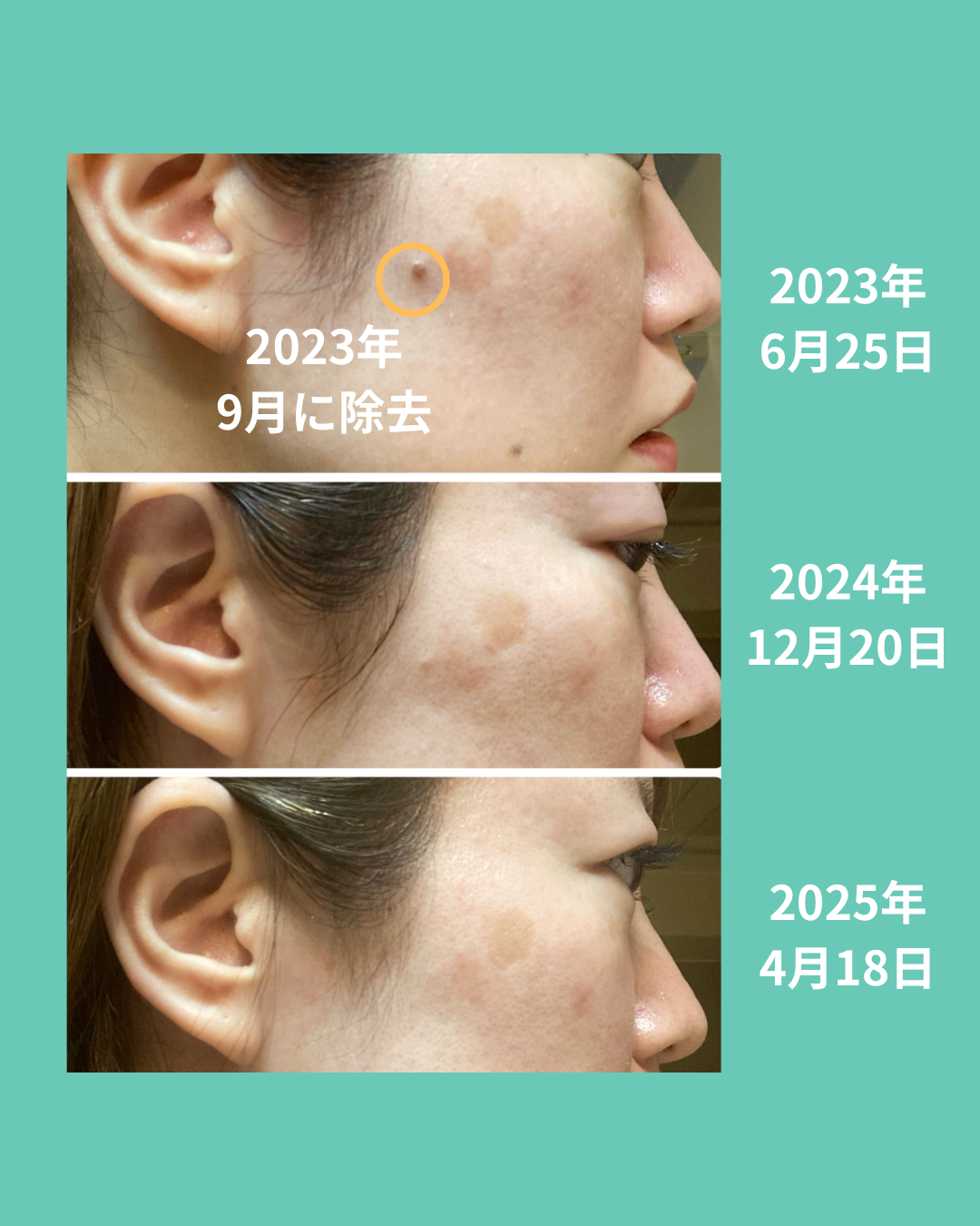 右頬のシミの経過②