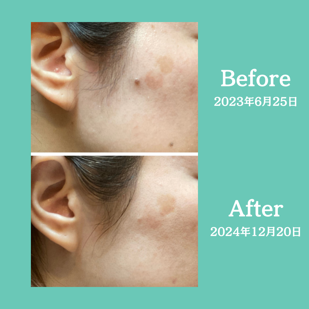右頬のシミの経過①