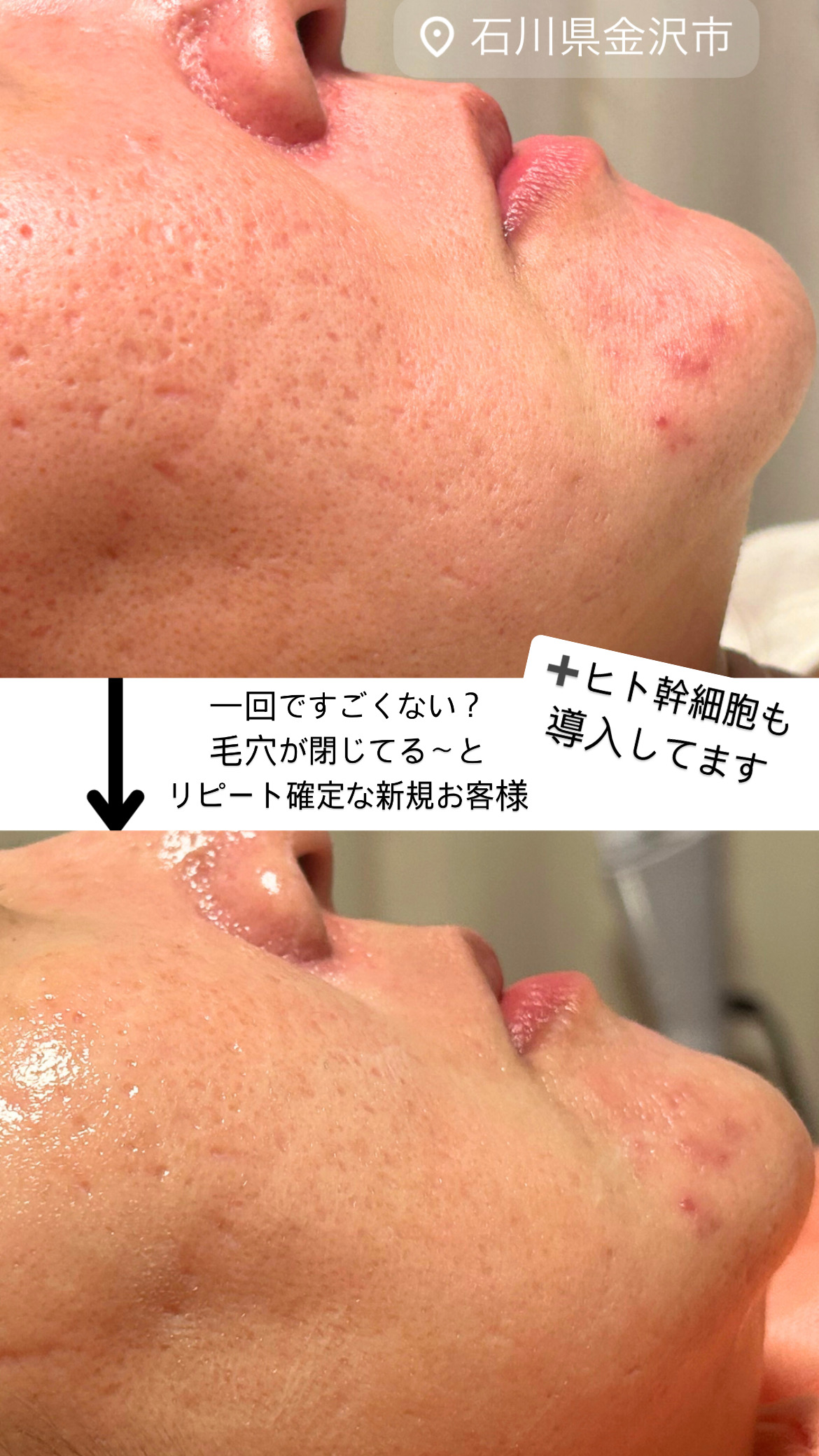 FAUスキンケアにて改善した画像その2