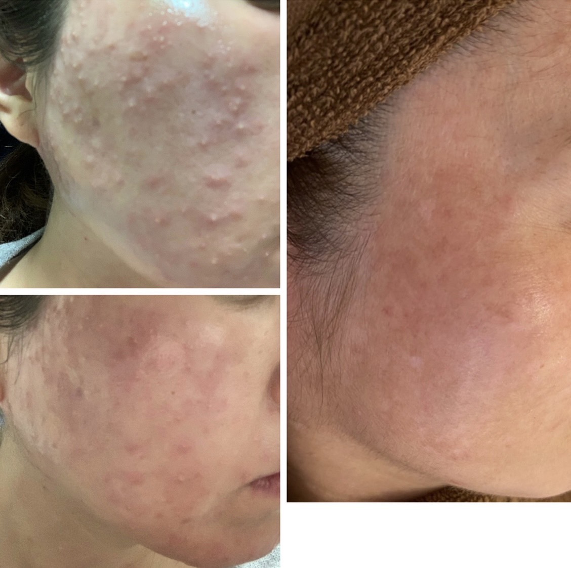 【モニター様募集します】半年間限定！ミヴェール肌改善モニタープロジェクト