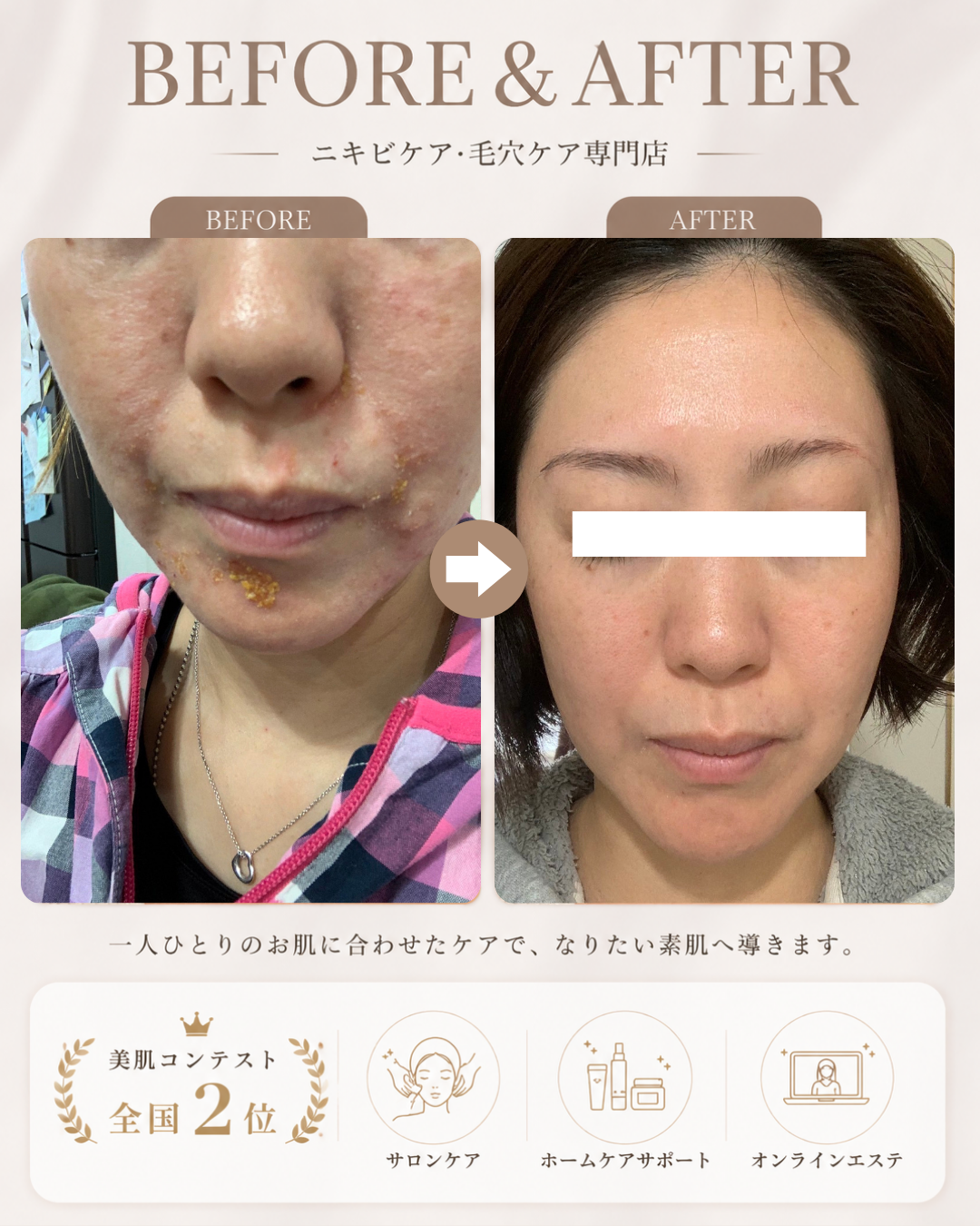 【肌改善症例】ヘイリー・ヘイリー病に悩まれていたお客様。オンラインから始めた肌ケア