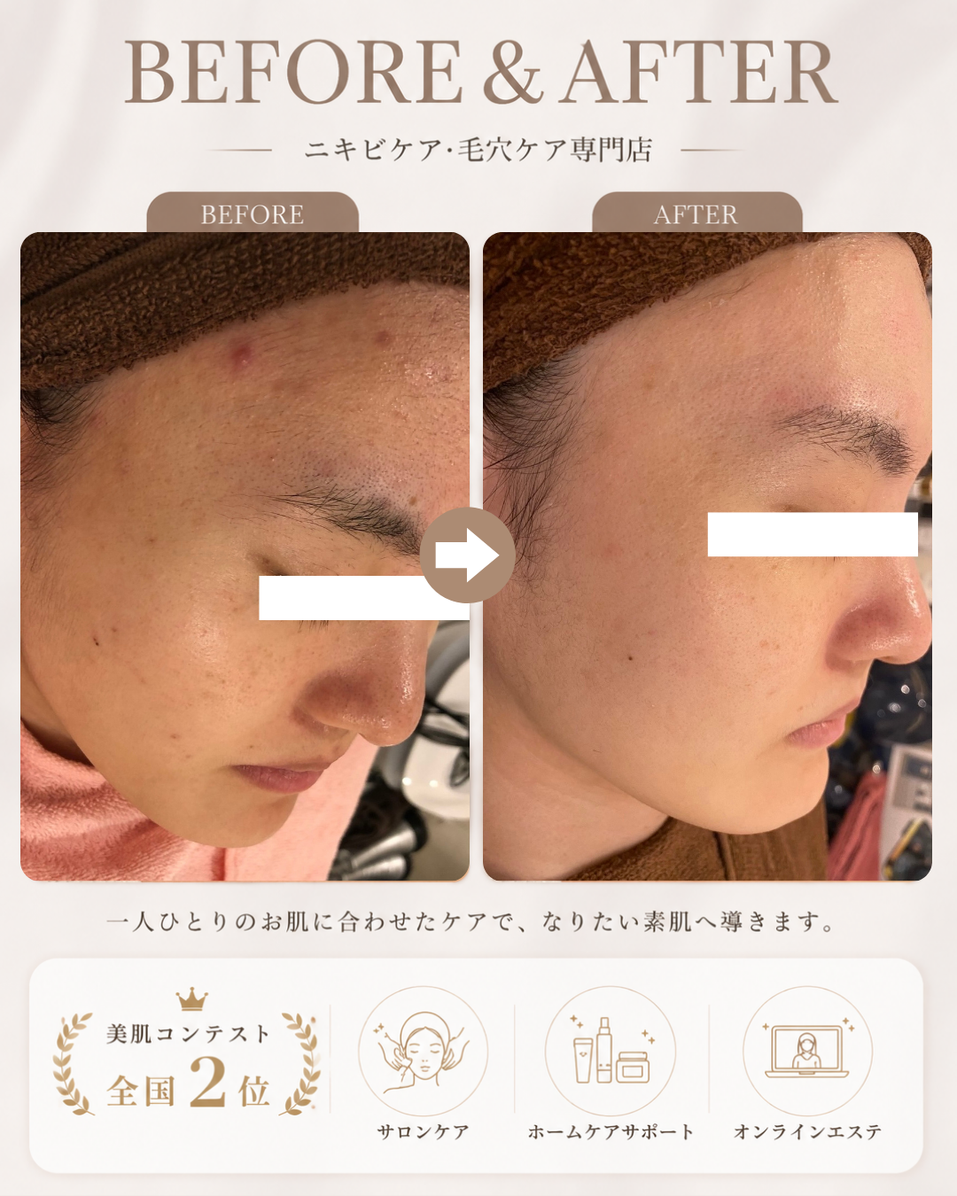 【症例紹介】生え際のニキビ・毛穴の黒ずみにお悩みの方へ