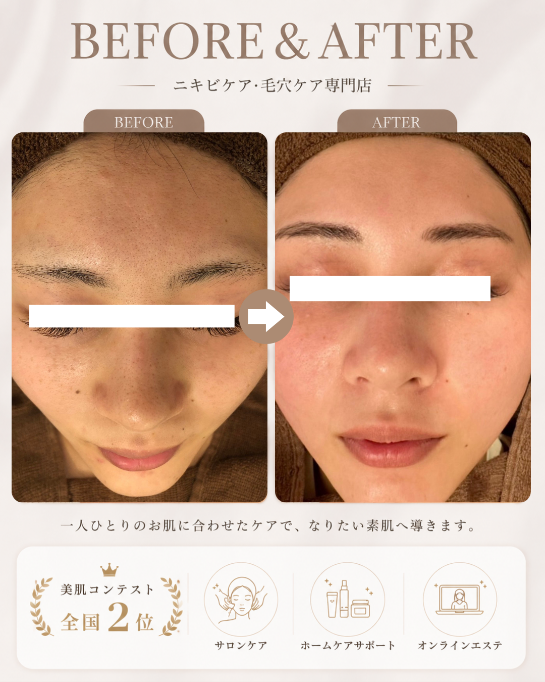 【症例紹介】毛穴の黒ずみ・くすみが気になるお肌へ