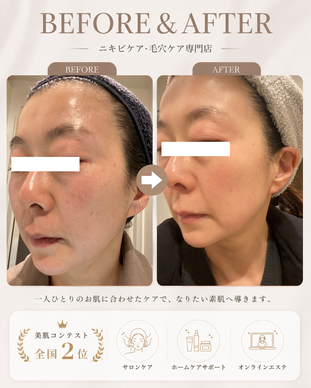 【シミ改善症例】気になっていたシミ・くすみに変化