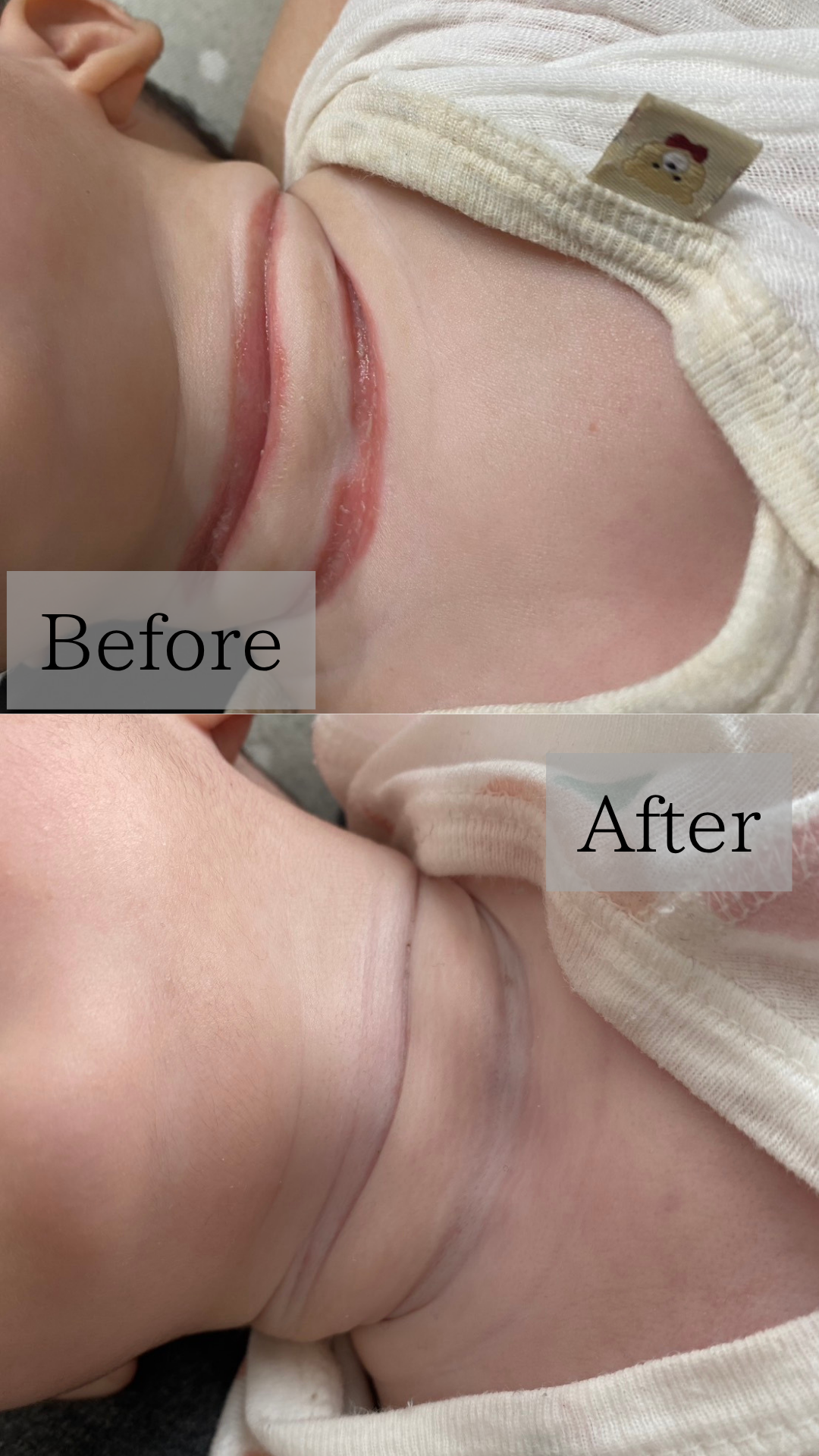 【 子どもの首の肌荒れケア 】ボディソープの選び方にも注意