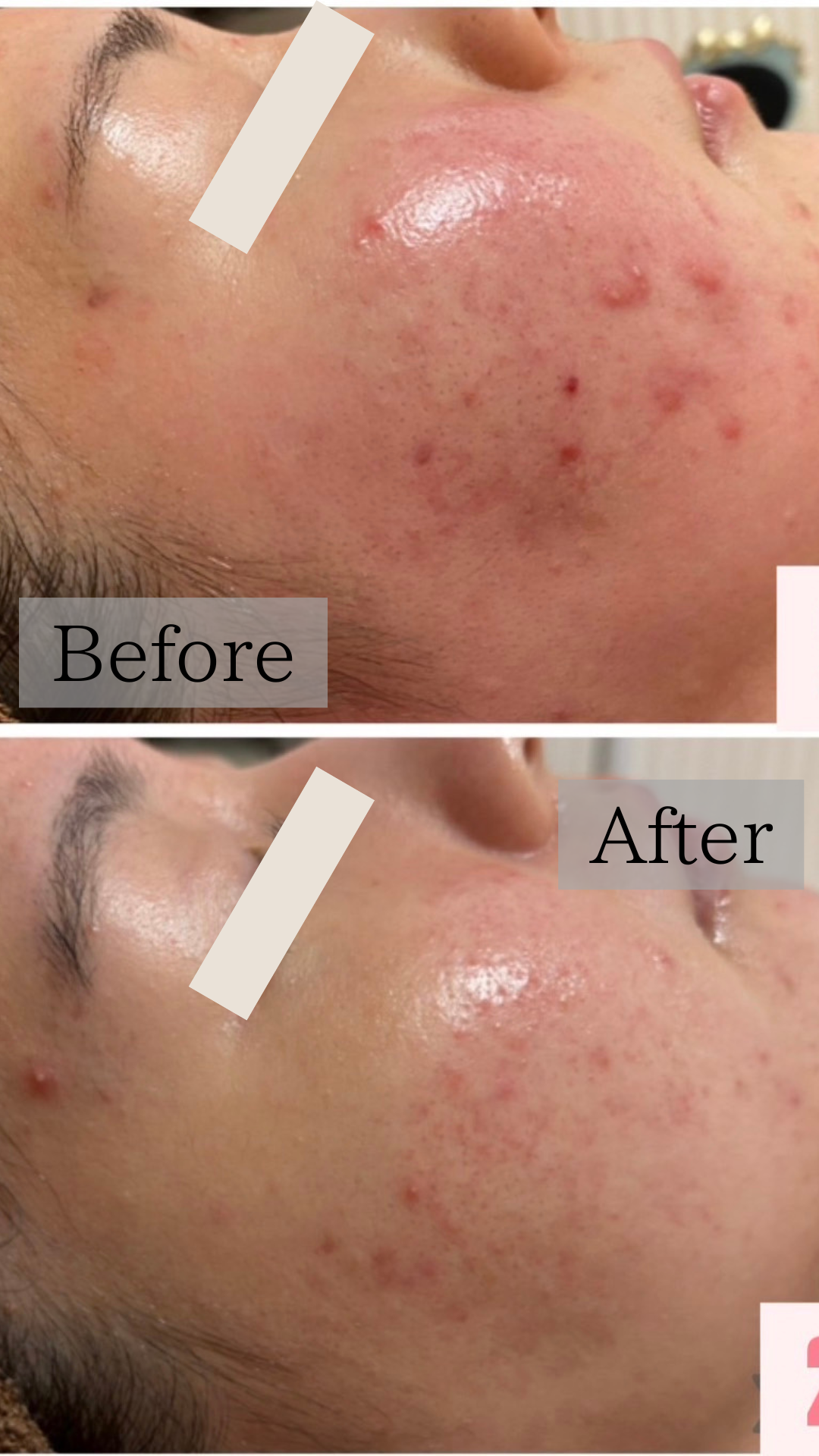 【古田担当お客様の変化】繰り返すニキビと赤みに悩んでいたA様の改善