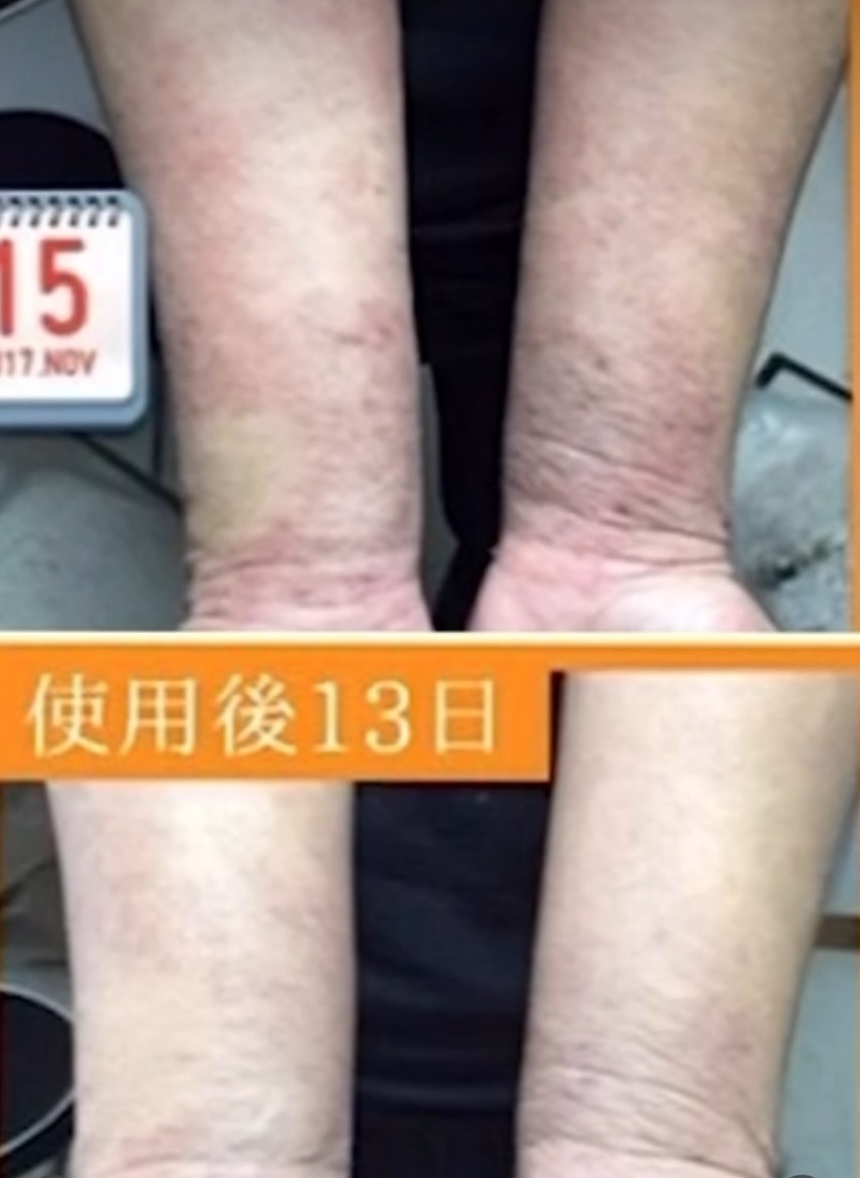 【症例紹介】ミヴェール バークセラムを使った肌変化