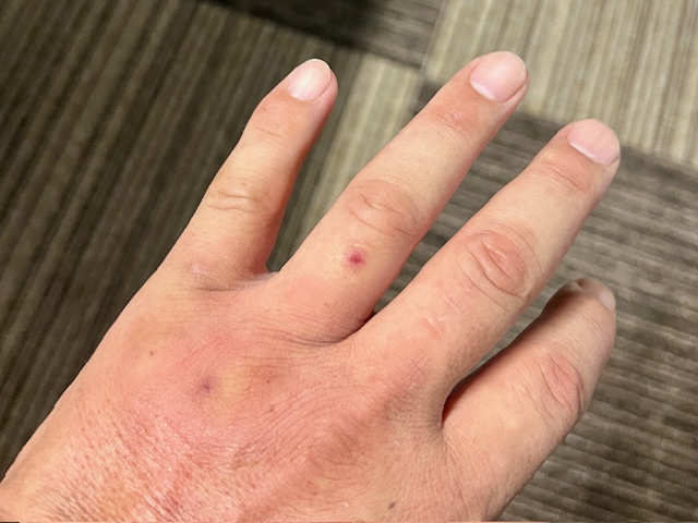蜂に刺されました…