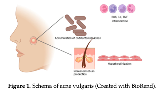 ティートゥリー精油はニキビにどう効く？