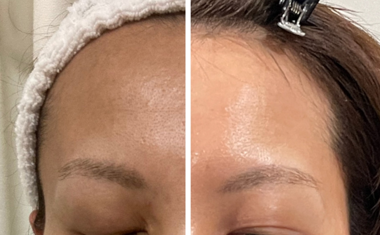 症例写真【くすみ、ニキビ、毛穴、敏感肌】
