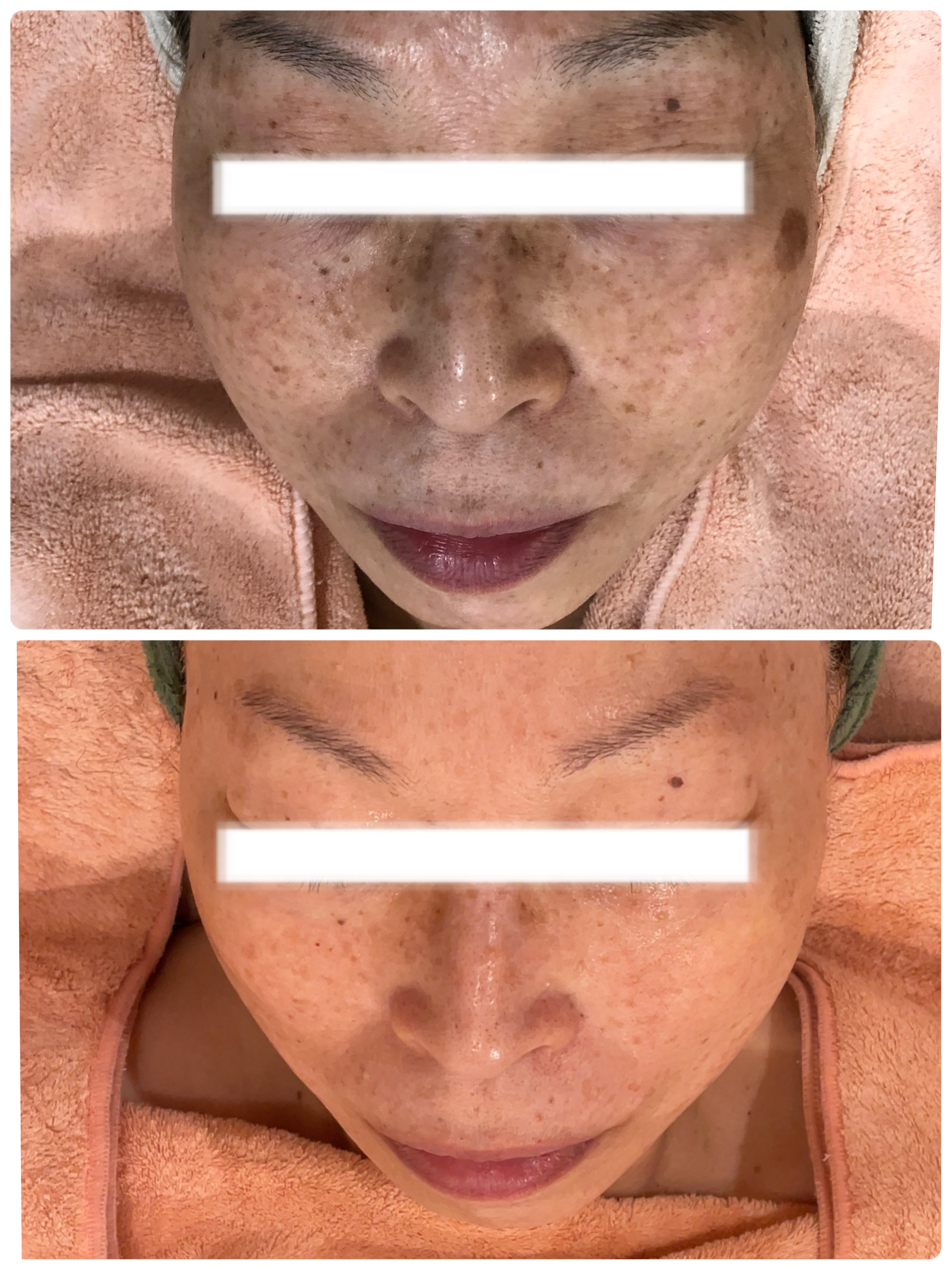 症例写真【しみ、しわ、敏感肌】