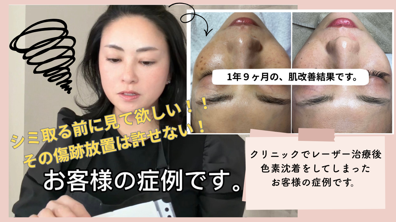 お客様の症例写真〜レーザー治療後の色素沈着編〜