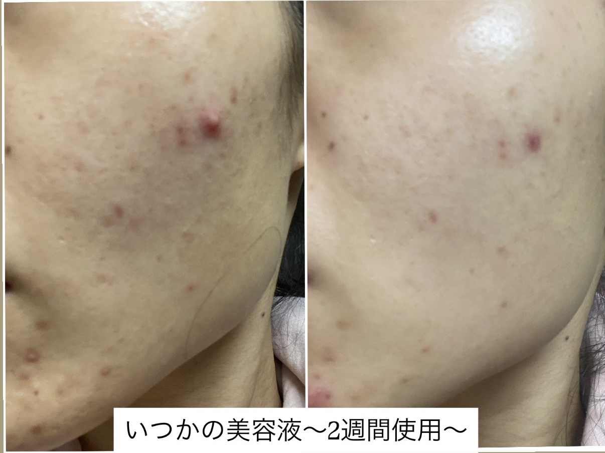 いつかの美容液〜症例お写真・2週間使用〜