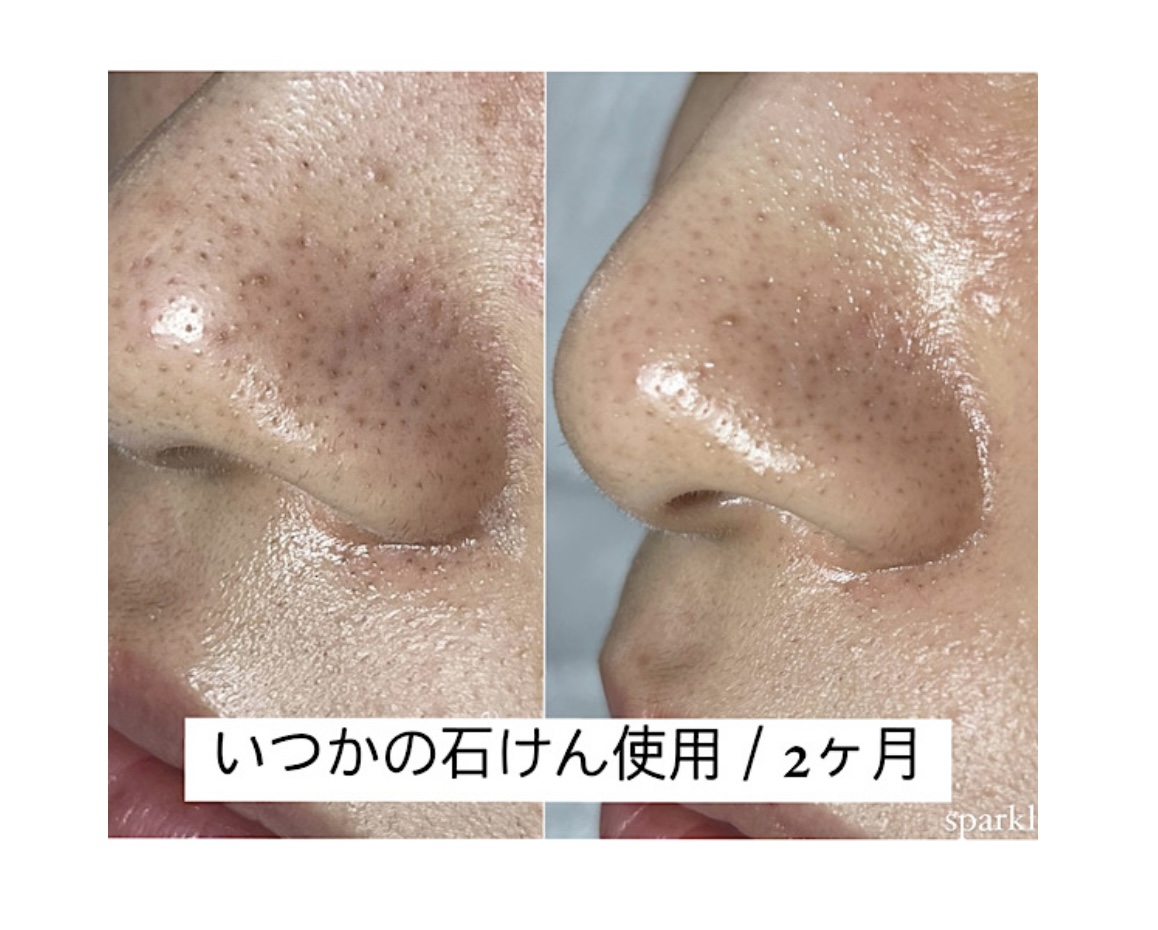 いつかの石けん使用の、お客様症例