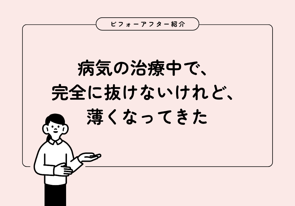 治療中の薄毛に広範囲カバーウィッグ|分け目の透け感をナチュラルにカバーした事例