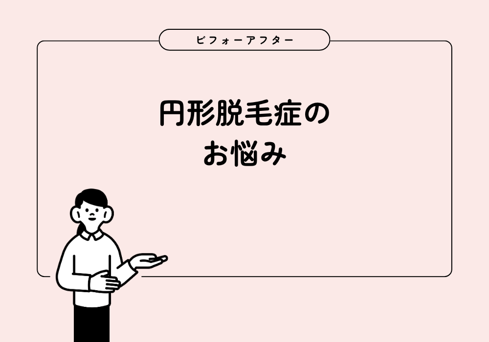 【リアル解決・ビフォーアフター】円形脱毛症のウィッグ選び。「絶対に隠す」か「なんとなくカバー」か?