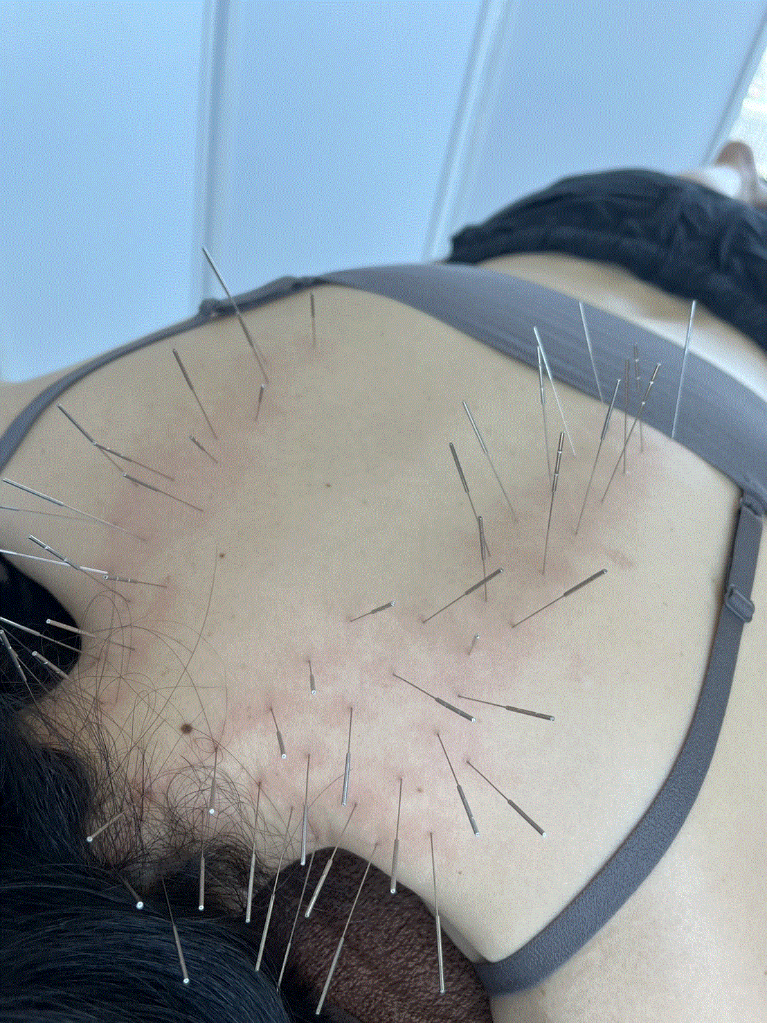 店主、ルート治療に行く～当日編