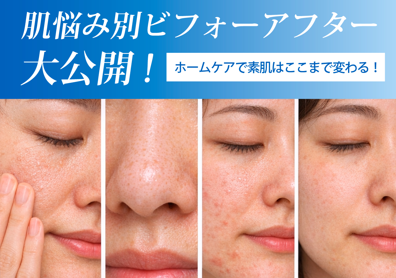 毛穴、ニキビ、くすみ。お悩み別ビフォーアフターを大公開！