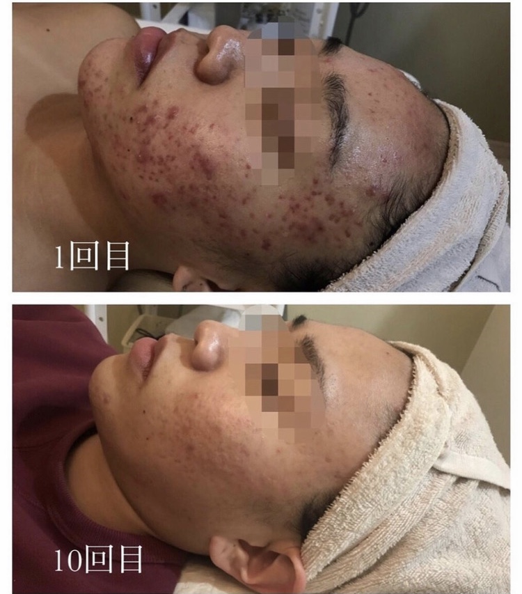 光フェイシャル　before・after
