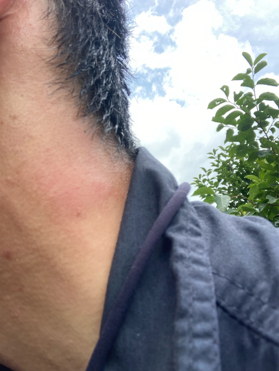 刺されたーー