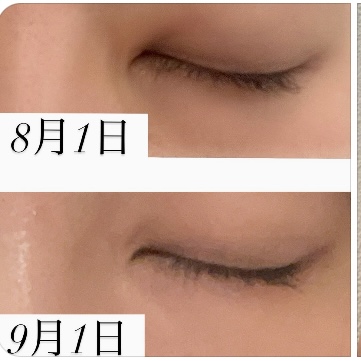 エクソソームで目元ケア✨