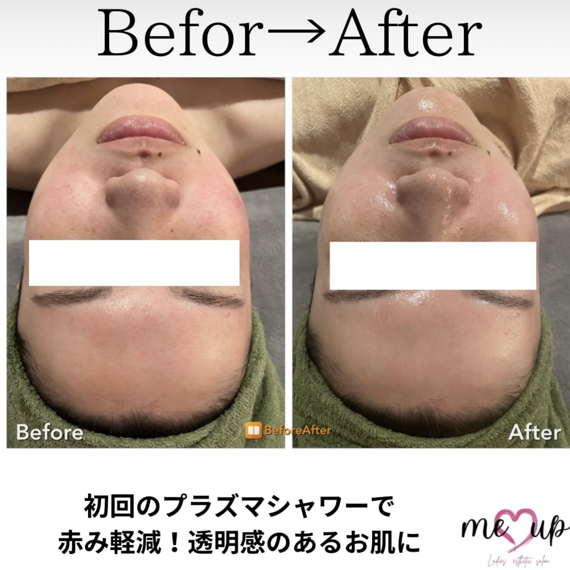 針を刺さないダーマペン✨