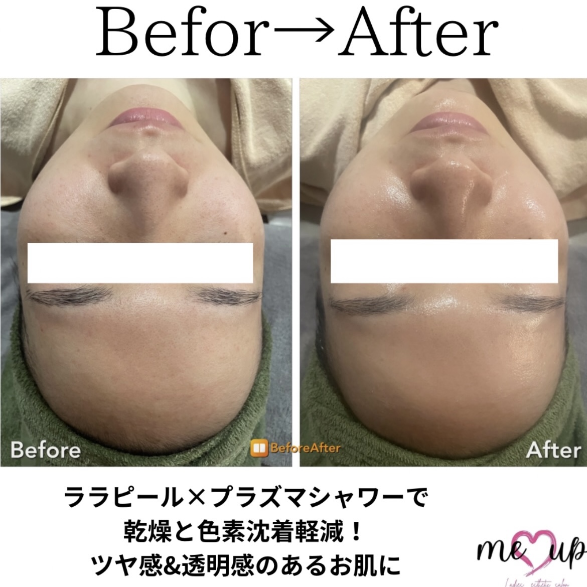 ララピール　×　プラズマシャワー