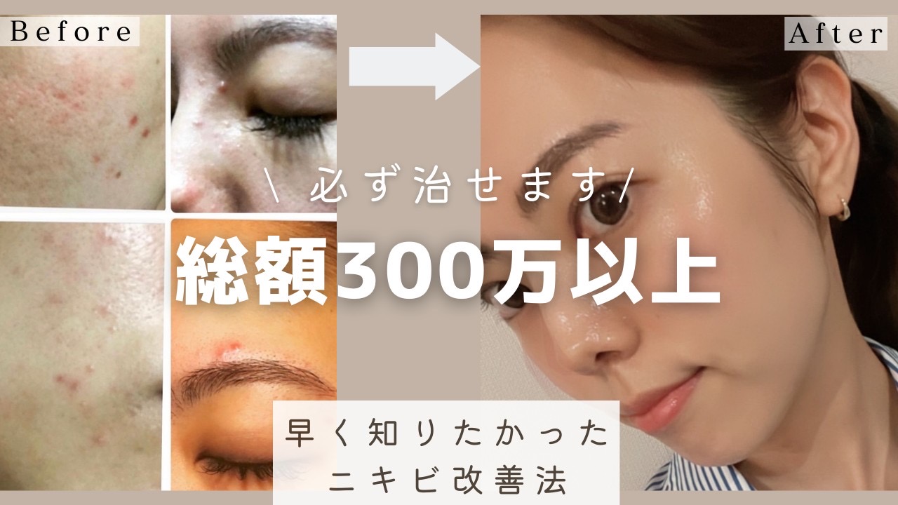 みないと損！ニキビ改善の最短ルート