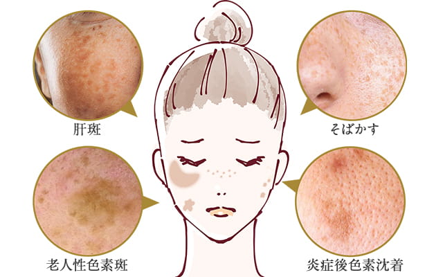 美白を目指すなら知っておきたい！しみの種類と原因