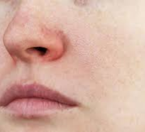 鼻の周りの赤みを軽減する方法