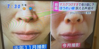 ほうれい線予防しないと・・・たるみ予防ケア！