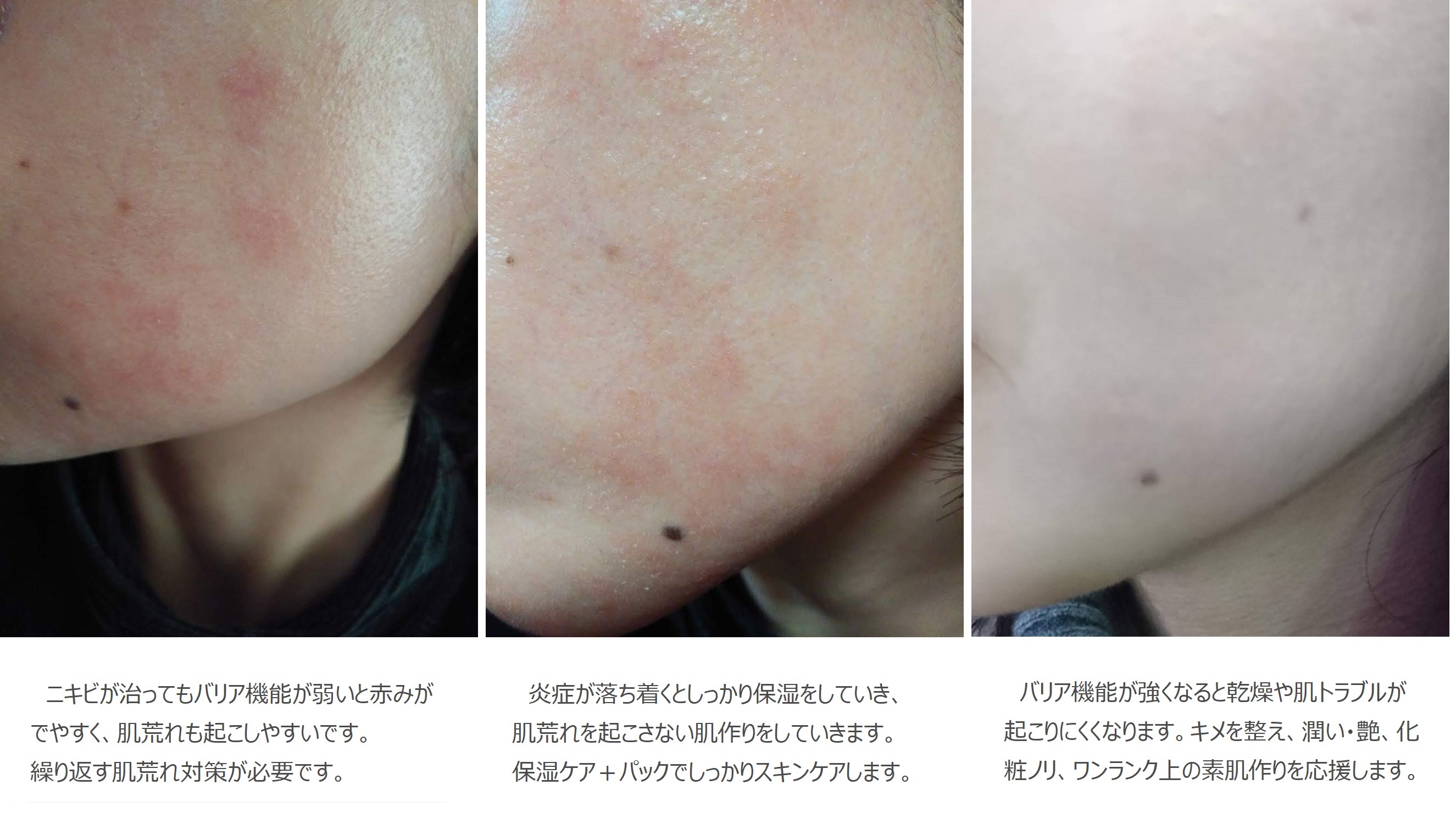 肌質改善 美肌サロン エステハウス アンディ 潤い美肌 スキンケアブランド Amulise 肌質改善 美肌サロン エステハウス アンディ 潤い美肌 スキンケアブランド Amulise